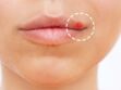 Bouton sur la lèvre : quelles sont les causes possibles et que faire ?