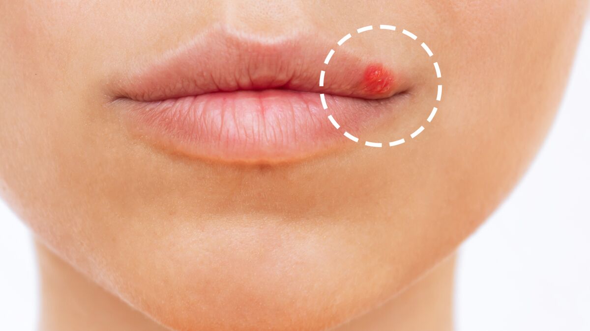 Bouton sur la lèvre : quelles sont les causes possibles et que ...