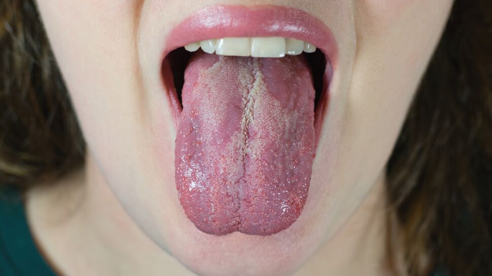 Syndrome de la "langue poilue" : comment expliquer ce phénomène identifié chez un Américain ?