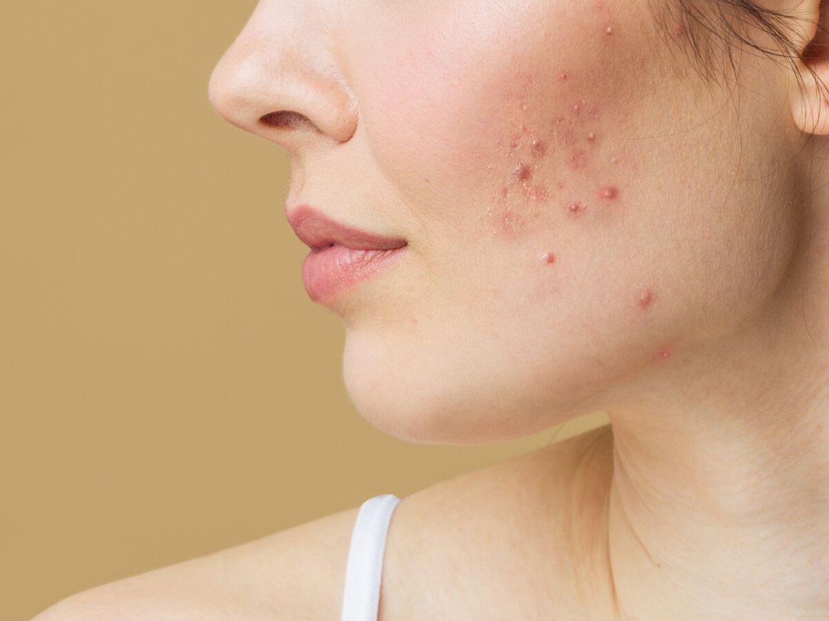 Cicatrice d'acné : les meilleures façons de les traiter selon une ...
