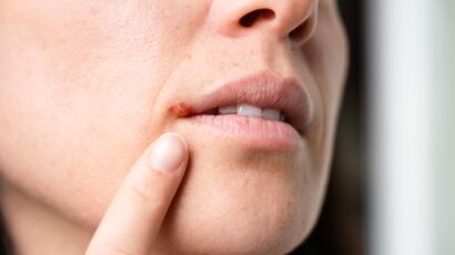 Bouton sur la lèvre : quelles sont les causes possibles et que ...
