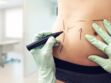 Laparotomie : à quoi correspond cette opération du ventre ?