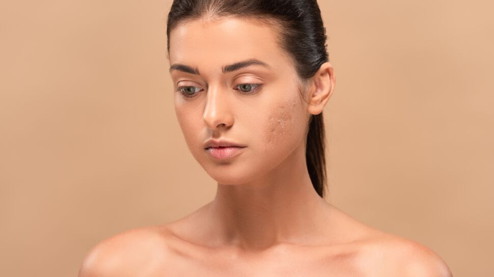 Cicatrices d'acné : l'erreur à éviter pour ne pas les aggraver, selon une dermatologue