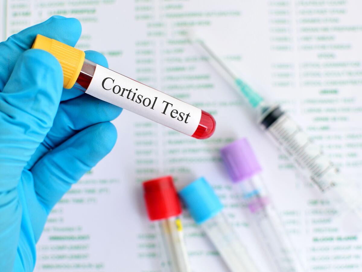 Examen d'urine - détection du syndrome de cushing par analyse d'urine sur  24H