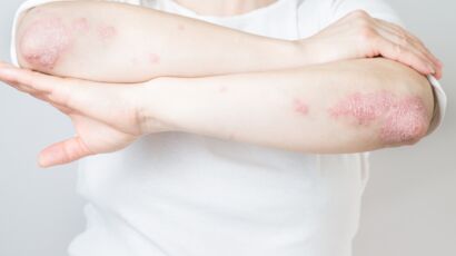   Severe psoriasis: here's why it increases the risk of cardiovascular disease  