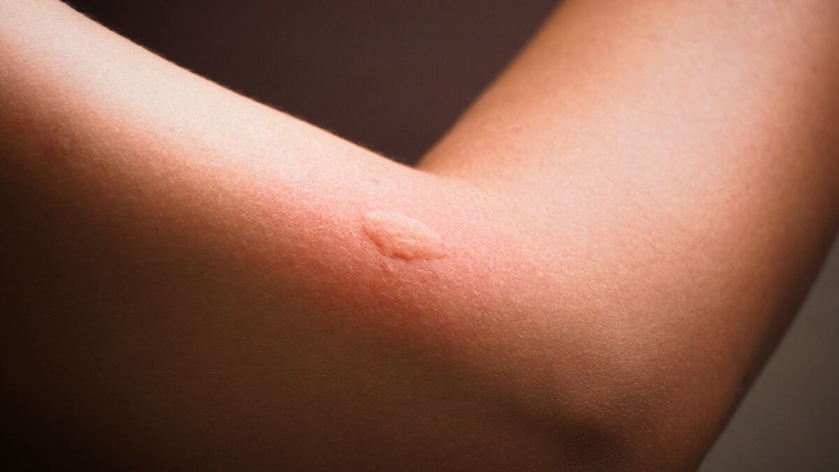 Allergie aux piqûres de moustiques : comment la soigner et que ...