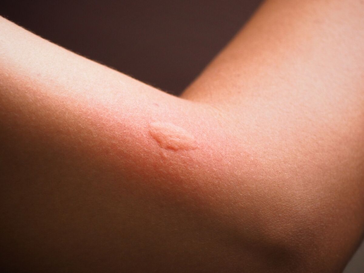 Allergie aux piqûres de moustiques : comment la soigner et que ...