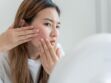Boutons, rougeurs : comment savoir si c’est de l’acné ou de la rosacée ? Une dermatologue répond
