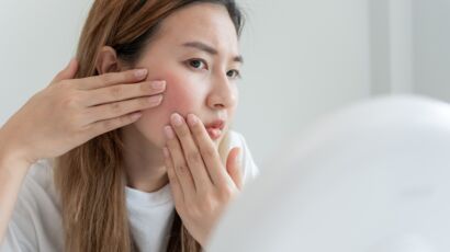 Microkyste au visage : comment s'en débarrasser ? : Femme Actuelle ...