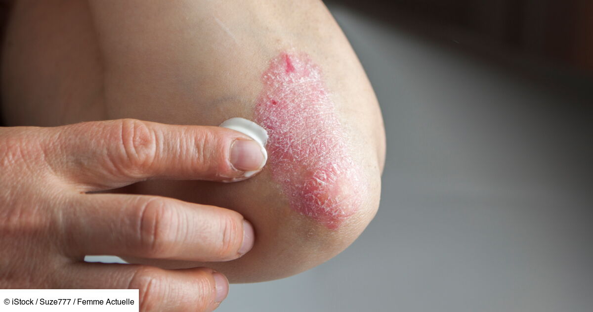 J'ai guéri du psoriasis les conseils d'une dermatologue pour mieux le — free download