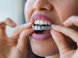 Aligneurs orthodontiques : dans quel cas porter des gouttières transparentes et combien ça coûte ? 