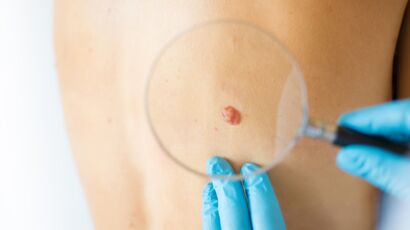 Melanoma: what are the promising new treatments for this skin cancer?