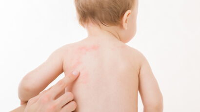 Roséole chez le bébé : comment reconnaître les boutons associés à cette maladie virale ?