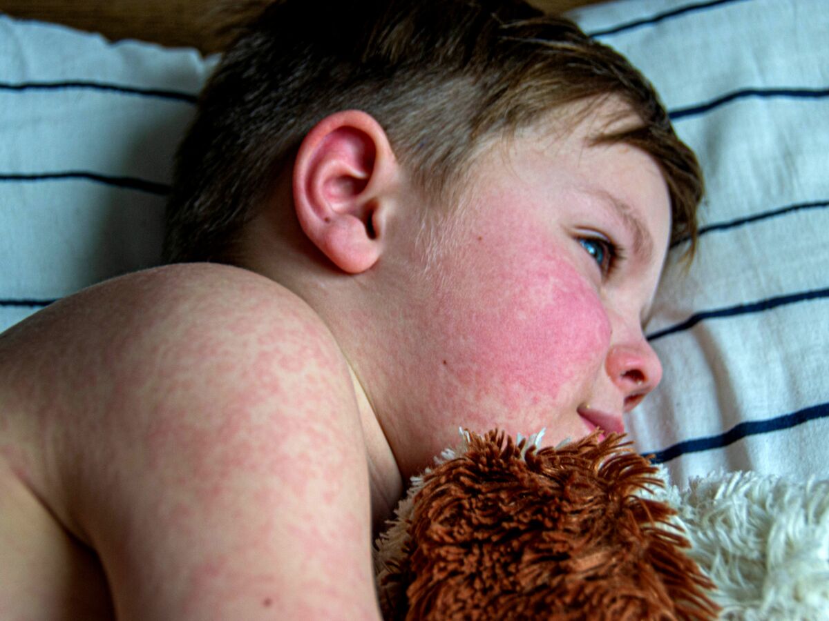 Épidémie de parvovirus B19 en France : quels sont les symptômes chez l’enfant ?