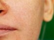 Comment atténuer l'apparence des pores dilatés et lisser le grain de peau ? 