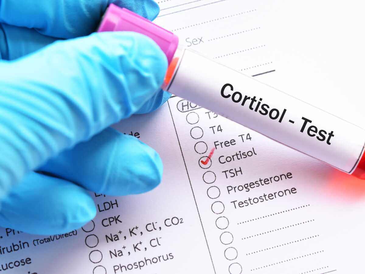 Qu'est-ce que l'hypercorticisme, ce trouble rare lié à un excès de cortisol ?