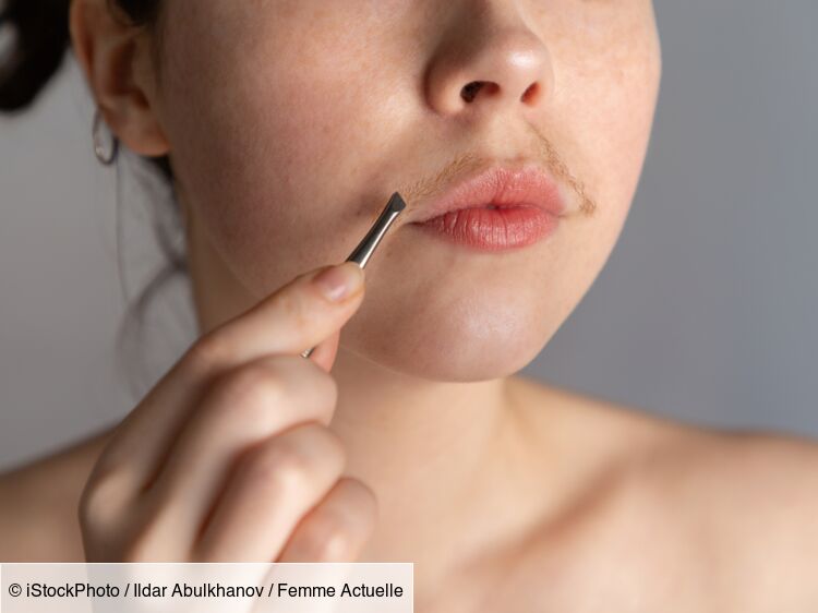 "Il faut arrêter de croire que c'est miraculeux" : pour se débarrasser de sa moustache, Marie s'astreint depuis 3 ans à des séances au laser, elle raconte sa frustration