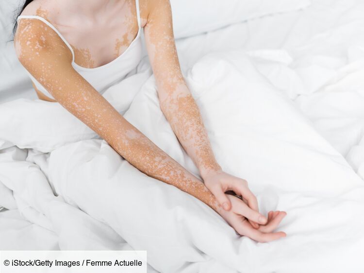 "Le vitiligo touche à l'image de soi" : une psychologue livre ses conseils pour apprivoiser cette maladie de peau (et 3 femmes témoignent)