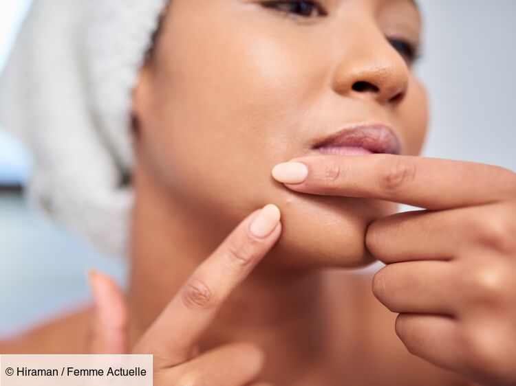 C'est l'ingrédient parfait pour venir à bout des pores dilatés sur le menton, d’après un expert