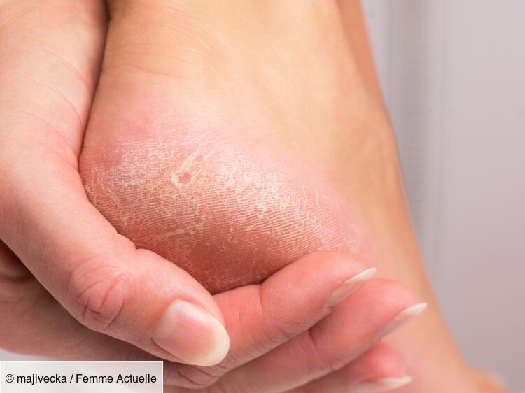 Vous avez les pieds secs et les talons fendillés ? Cet ingrédient naturel fait des miracles, selon une experte