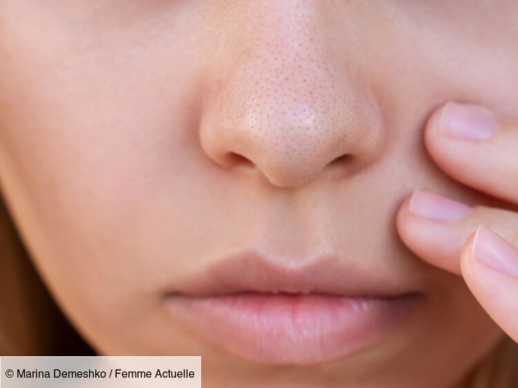 Les ingrédients à utiliser pour venir à bout des filaments sébacés sur le nez, selon une dermatologue