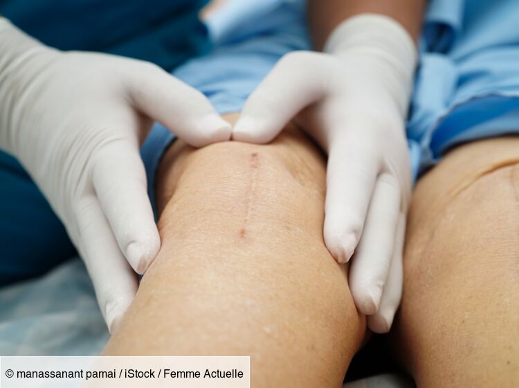 Prothèses de genou contre l’arthrose : leur nombre a doublé en 15 ans, sont-elles toujours justifiées ?