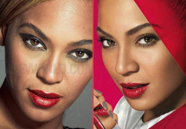 Beyoncé, les boutons d'acné en moins