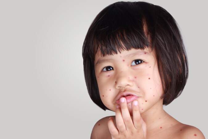 Bicarbonate de soude : un bain et un cataplasme contre la varicelle