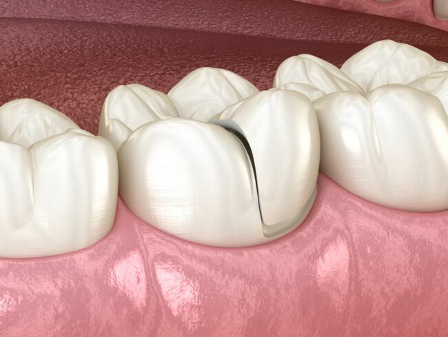 Bridge dentaire : les avantages et les inconvénients de ce type de prothèse  : Femme Actuelle Le MAG