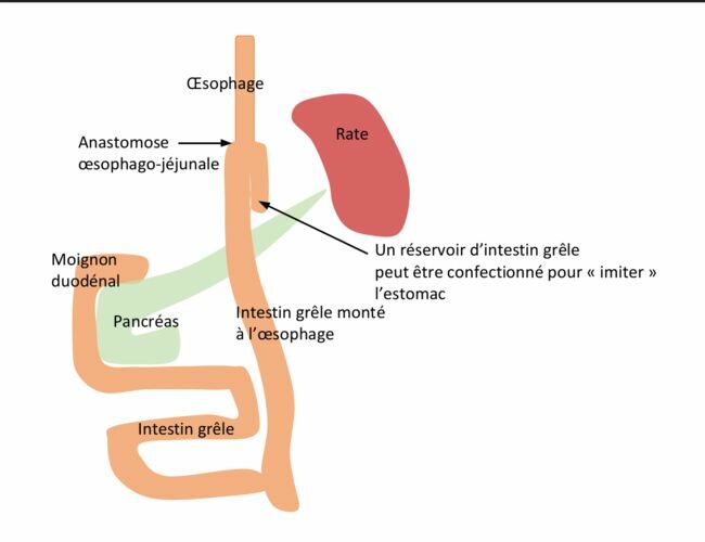 Ce schéma représente la reconstruction après gastrectomie totale avec de l’intestin grêle. Dans ce cas, un réservoir (en « J ») peut être confectionné.