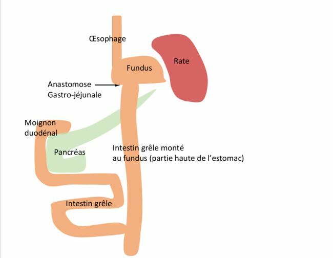  Ce schéma représente la reconstruction après gastrectomie des 4/5ème avec de l’intestin grêle. L’intestin grêle est anastomosé au fundus qui est la partie de l’estomac que l’on préserve.