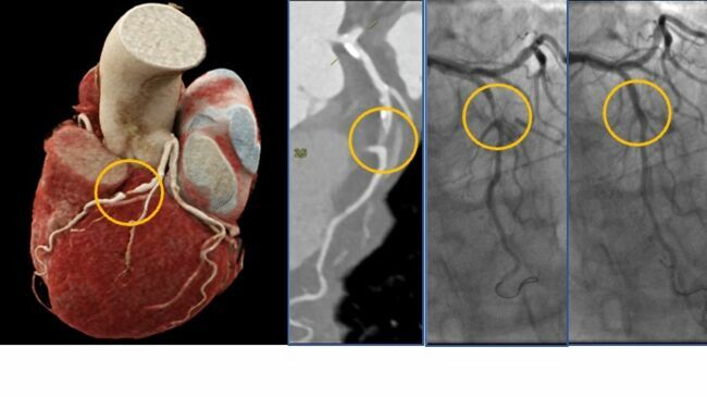 Une image de scanner et sa corrélation à la coronarographie avant et après angioplastie